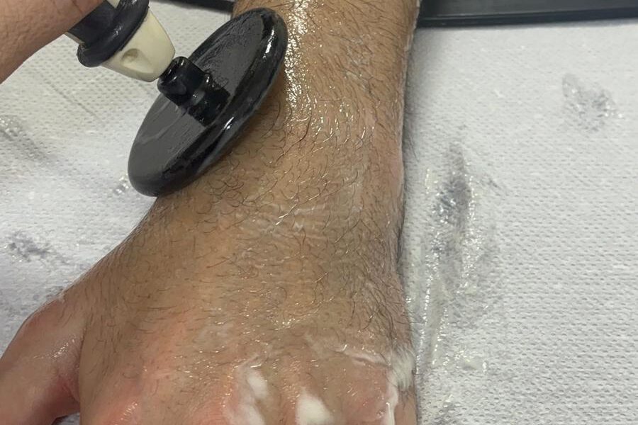 Tratamiento con Radiofrecuencia para lesiones de muñeca Tratamiento con Radiofrecuencia para lesiones de muñeca