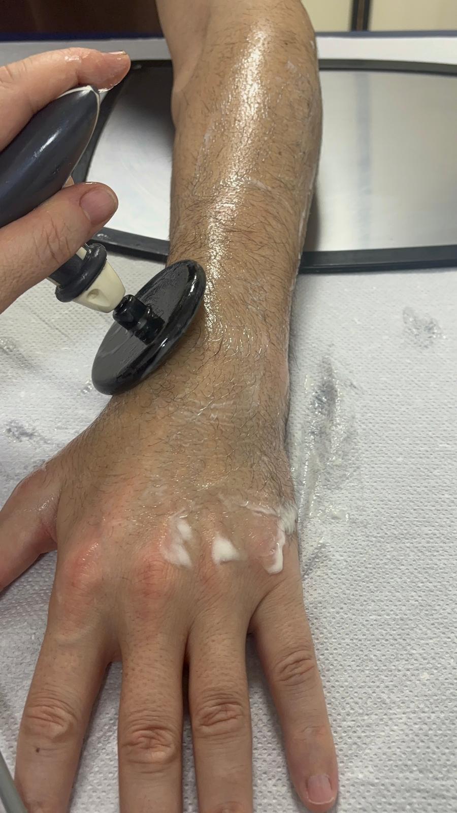 Tratamiento con Radiofrecuencia para lesiones de muñeca