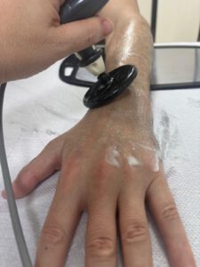 Radiofrecuencia para lesiones de muñeca