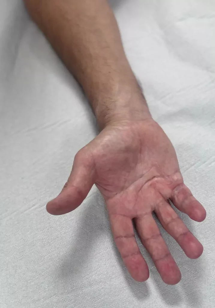 inicio Cicatriz rígida tras cirugía de Dupuytren