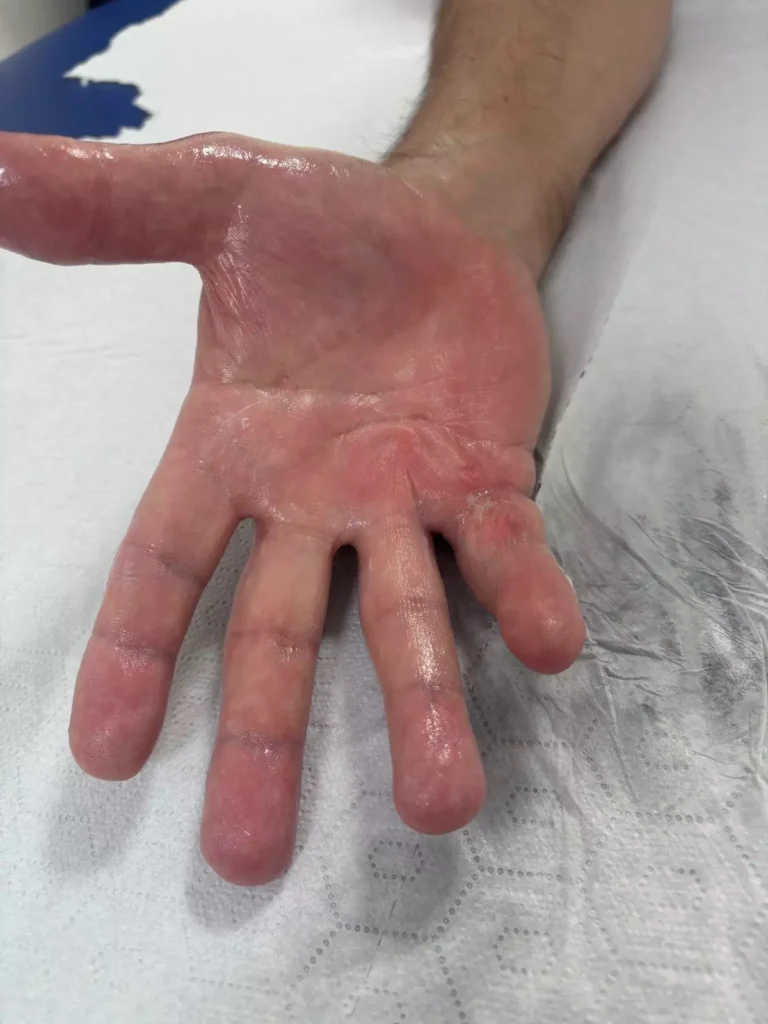 resultado de inicio Cicatriz rígida tras cirugía de Dupuytren