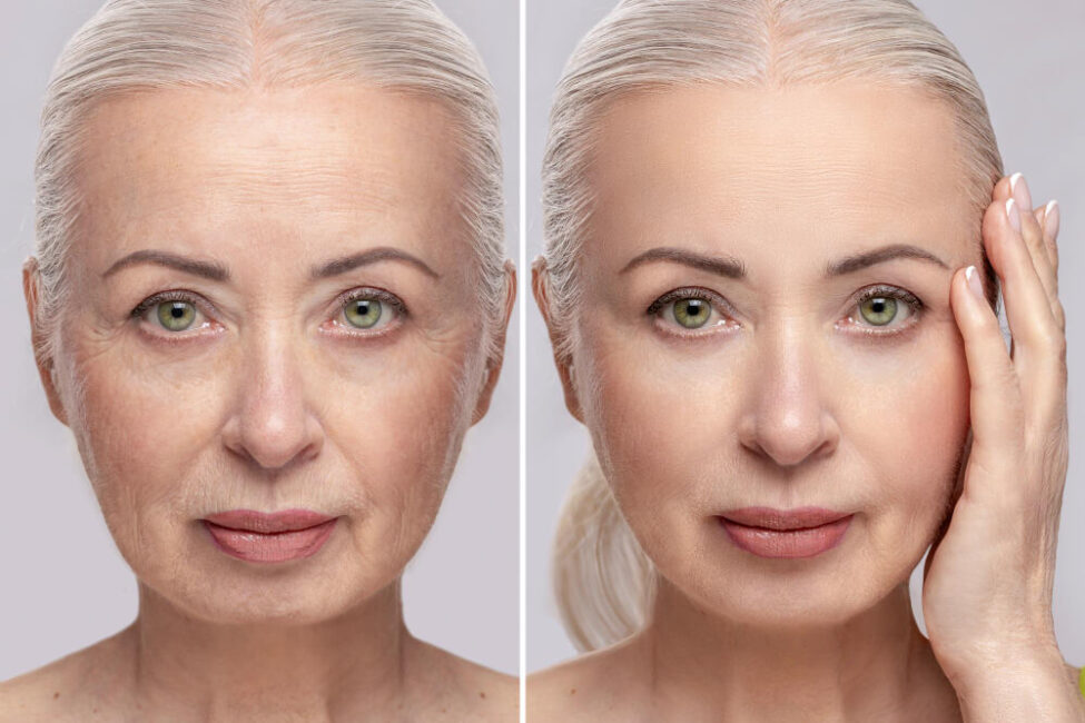 Beneficios del rejuvenecimiento facial con radiofrecuencia Beneficios del rejuvenecimiento facial con radiofrecuencia