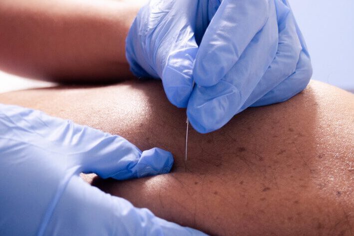 Recuperación Muscular y Articular con Acupuntura y Punción Seca Recuperación Muscular y Articular con Acupuntura y Punción Seca