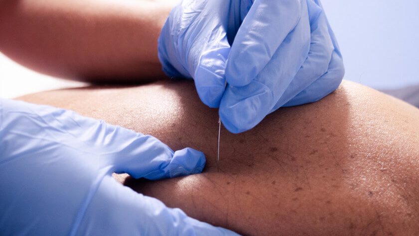 Recuperación Muscular y Articular con Acupuntura y Punción Seca Recuperación Muscular y Articular con Acupuntura y Punción Seca