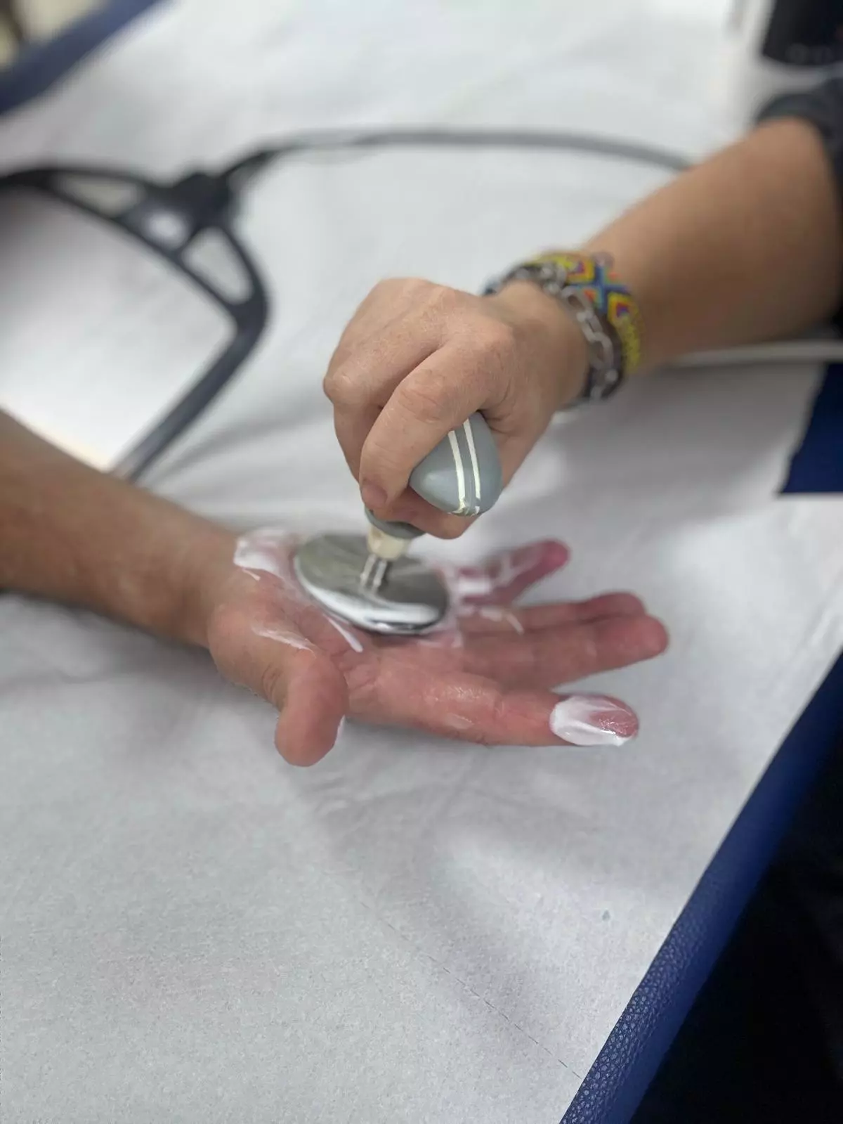 Cicatriz rígida tras cirugía de Dupuytren